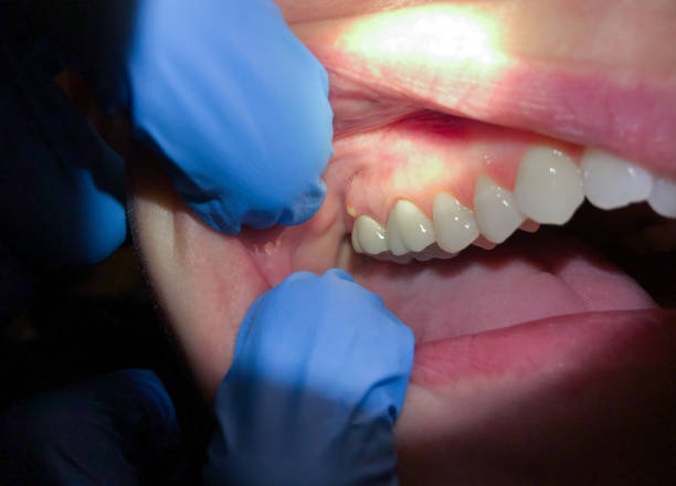 Best Urgent Tooth Repair  in Lake Holiday, IN