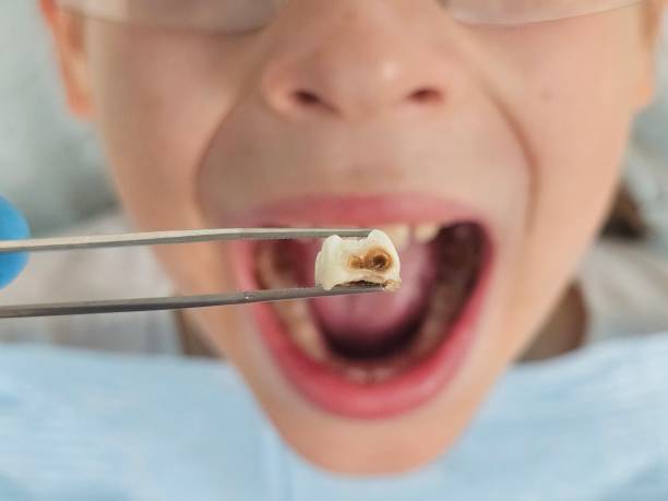 Best Cracked Tooth Emergency Dentist  in Lake Holiday, IN
